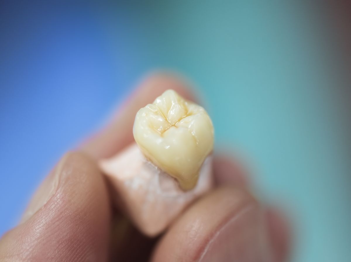 Dental Crowns