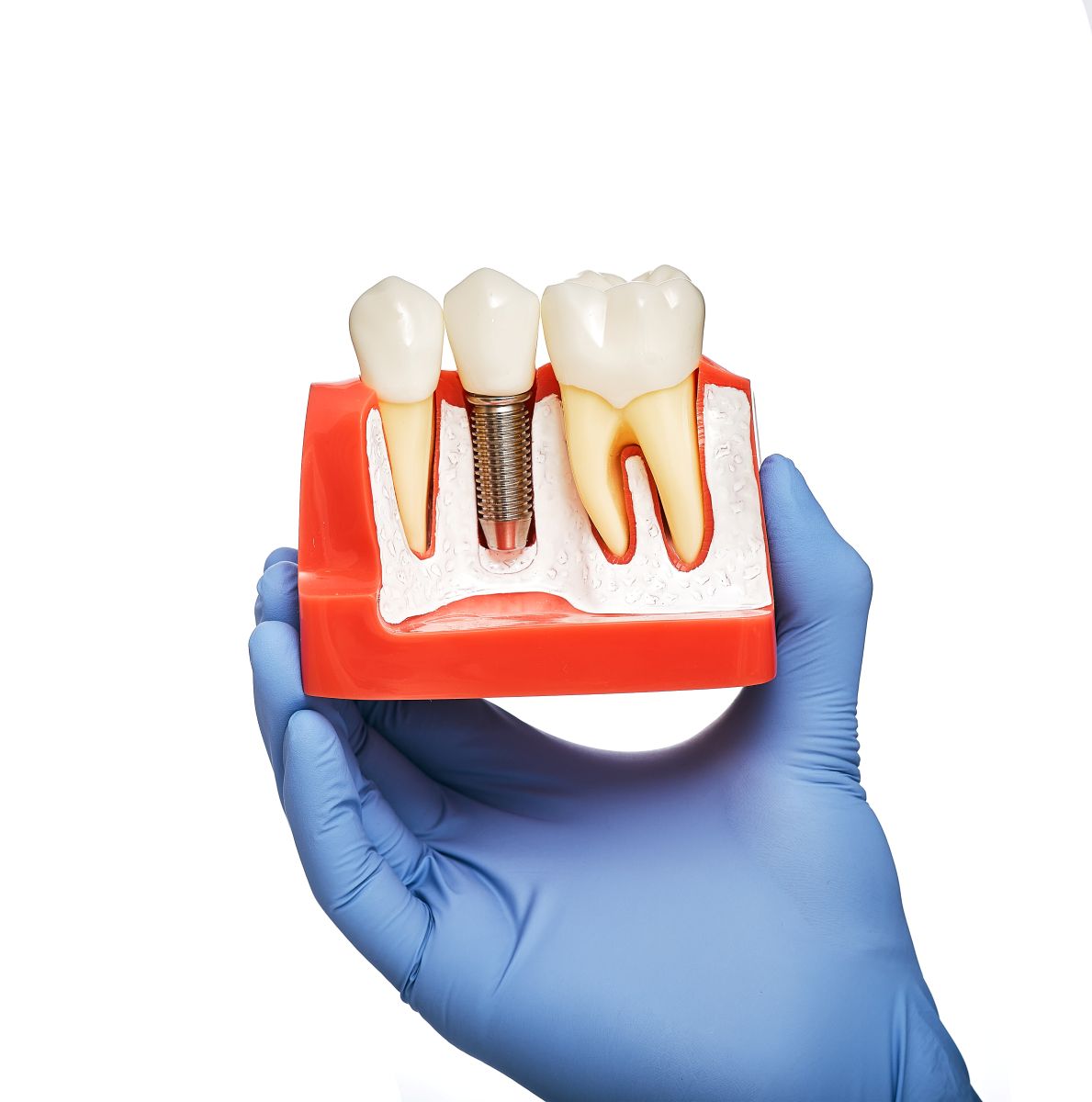 Dental Implants