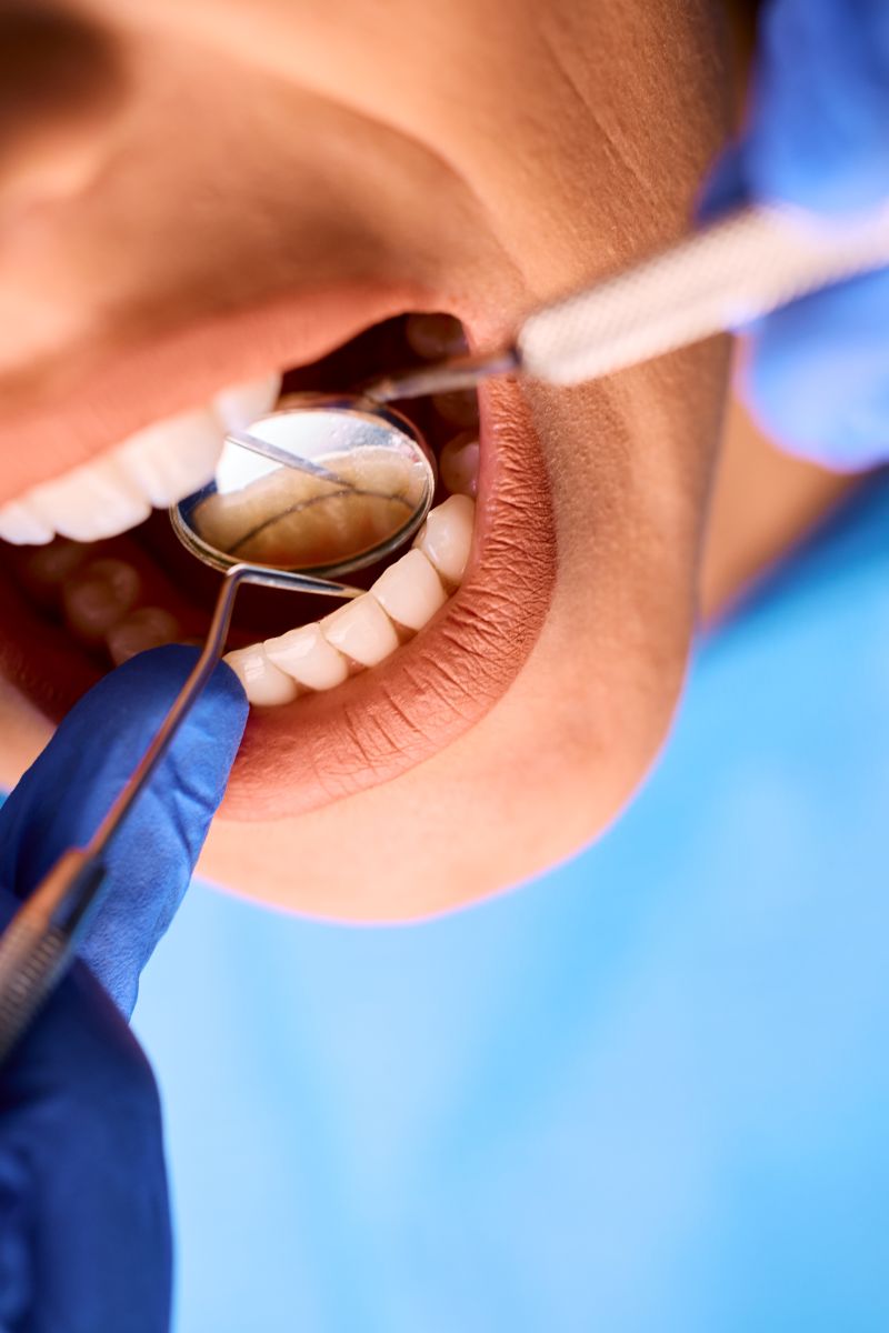 Fillings & Restorations