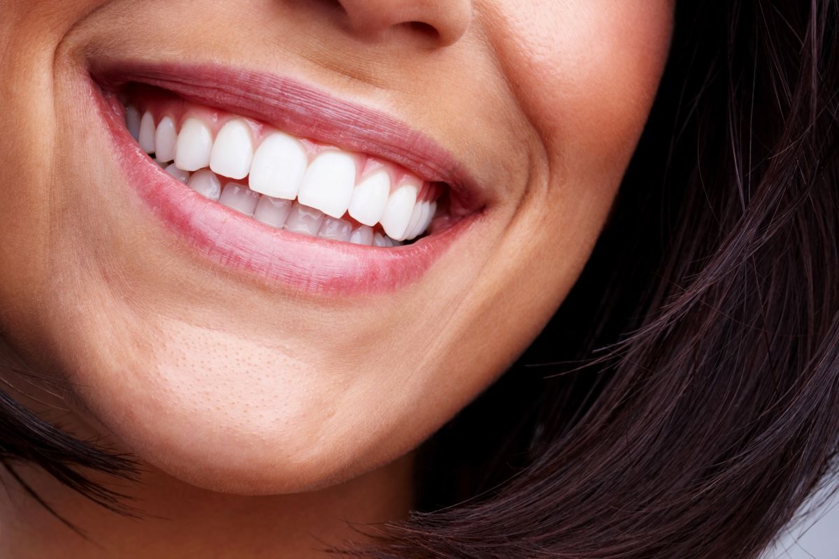 Veneers