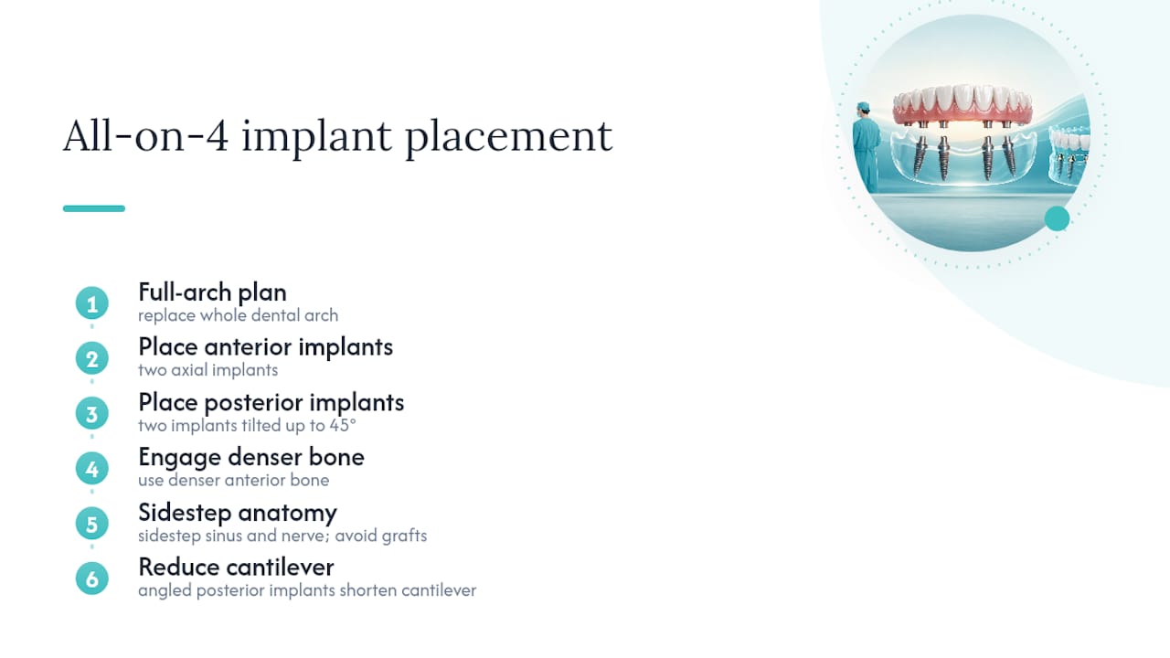Diagram of All-on-4 implant placement process
