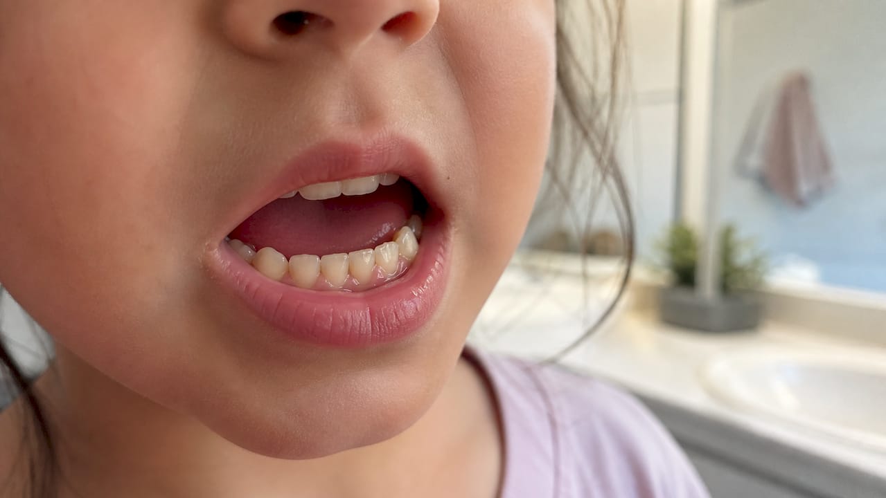Close-up of teeth with fluoride varnish tint