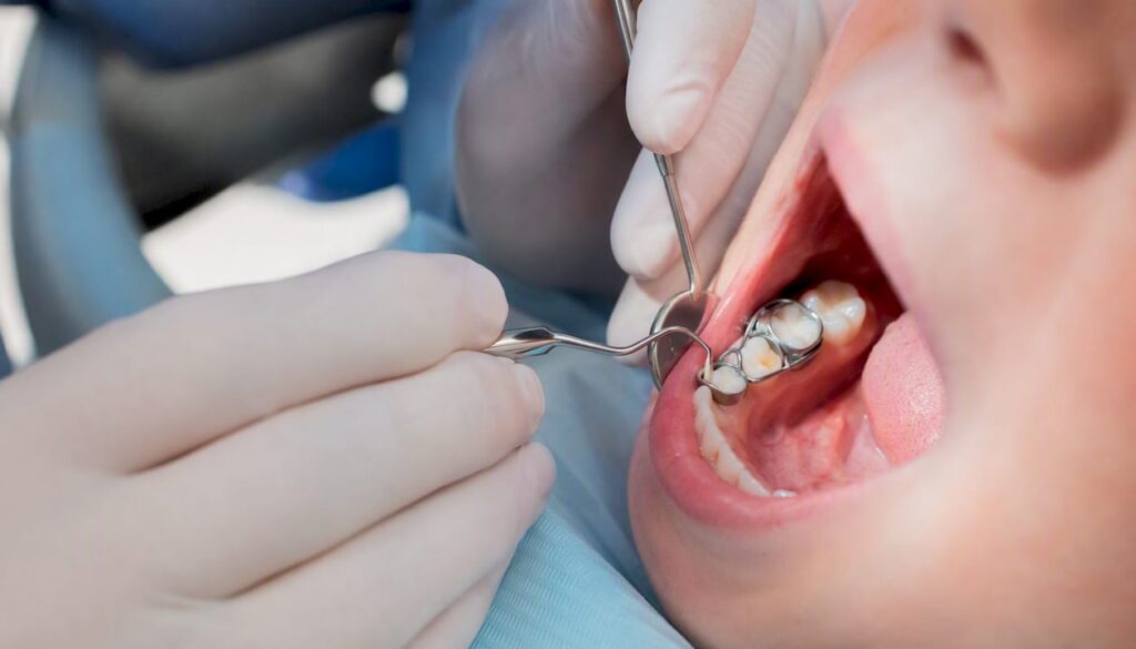 Hands fitting child’s dental space maintainer