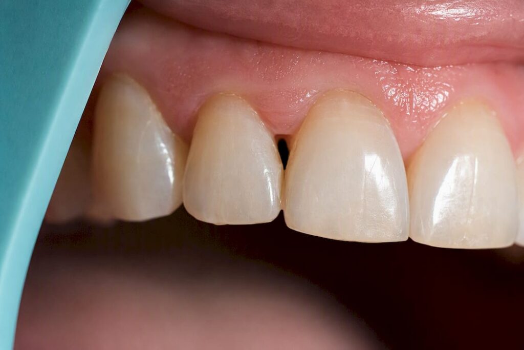 Black triangle gap between front teeth
