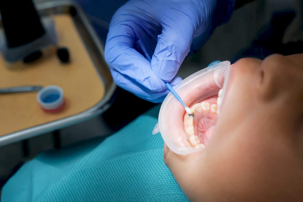 Clinician applying SDF to a primary tooth