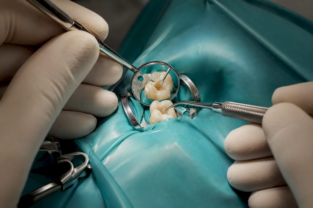 Rubber dam isolating tooth during filling
