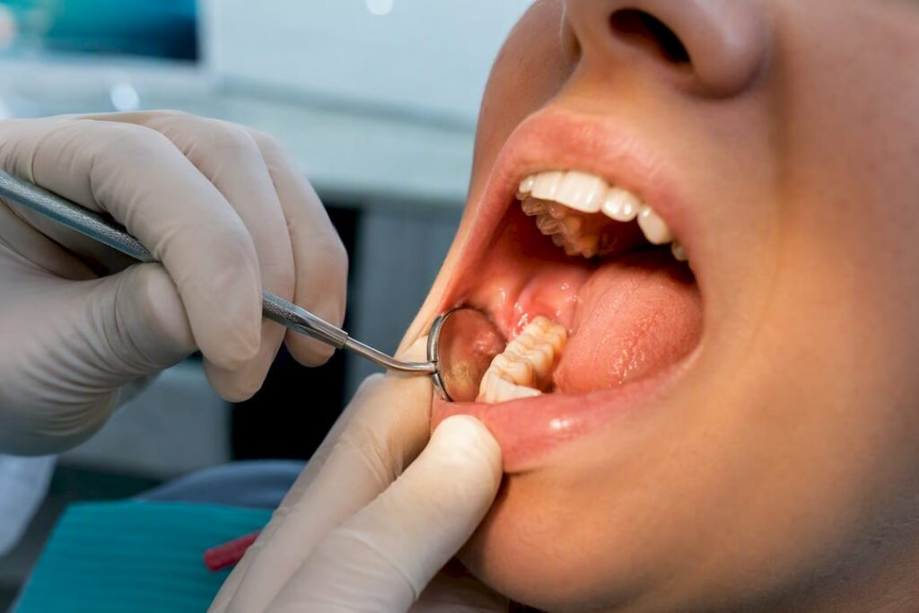 Swollen gum flap around partially erupted wisdom tooth