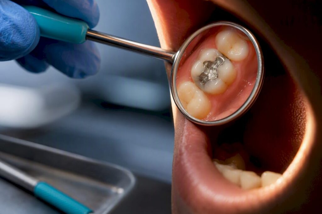 Dental mirror reflecting molar and gumline